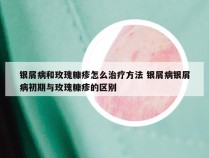银屑病和玫瑰糠疹怎么治疗方法 银屑病银屑病初期与玫瑰糠疹的区别
