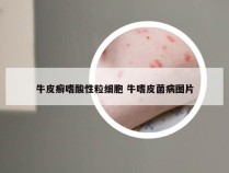 牛皮癣嗜酸性粒细胞 牛嗜皮菌病图片