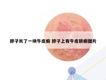 脖子长了一块牛皮癣 脖子上有牛皮肤癣图片