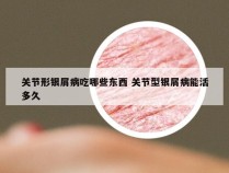 关节形银屑病吃哪些东西 关节型银屑病能活多久