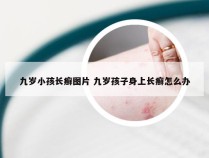 九岁小孩长癣图片 九岁孩子身上长癣怎么办