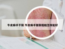 牛皮癣手干裂 牛皮癣手皲裂粗糙怎样能好