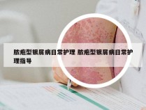 脓疱型银屑病日常护理 脓疱型银屑病日常护理指导