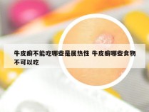 牛皮癣不能吃哪些是属热性 牛皮癣哪些食物不可以吃