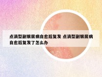 点滴型副银屑病自愈后复发 点滴型副银屑病自愈后复发了怎么办