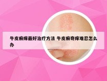 牛皮癣痒最好治疗方法 牛皮癣奇痒难忍怎么办
