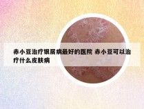 赤小豆治疗银屑病最好的医院 赤小豆可以治疗什么皮肤病