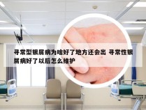 寻常型银屑病为啥好了地方还会出 寻常性银屑病好了以后怎么维护