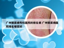 广州银屑病专科医院的排名病 广州银屑病医院排名哪家好