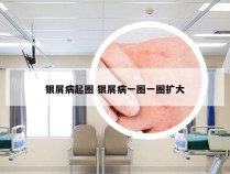 银屑病起圈 银屑病一圈一圈扩大