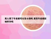 男人得了牛皮癣可以生小孩吗 男性牛皮癣影响怀孕吗