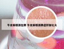 牛皮癣根源在脾 牛皮癣根源脾虚肝郁化火
