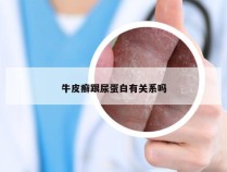 牛皮癣跟尿蛋白有关系吗