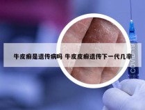 牛皮癣是遗传病吗 牛皮皮癣遗传下一代几率