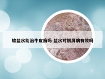 输盐水能治牛皮癣吗 盐水对银屑病有效吗