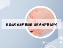 银屑病可能用芦荟面膜 银屑病擦芦荟会好吗
