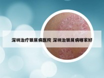 深圳治疗银屑病医院 深圳治银屑病哪家好