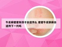 牛皮癣爸爸有孩子会遗传么 爸爸牛皮肤癣会遗传下一代吗