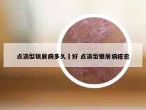 点滴型银屑病多久會好 点滴型银屑病痊愈
