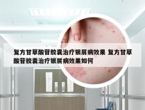 复方甘草酸苷胶囊治疗银屑病效果 复方甘草酸苷胶囊治疗银屑病效果如何