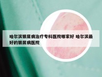 哈尔滨银屑病治疗专科医院哪家好 哈尔滨最好的银屑病医院
