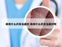 癣用什么药膏治最好 癣用什么药膏治最好呢