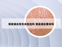 银屑病会有生命危险吗 银屑病会要命吗