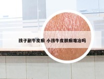 孩子副牛皮癣 小孩牛皮肤癣难冶吗