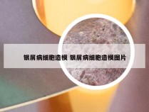 银屑病细胞造模 银屑病细胞造模图片