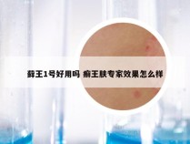 藓王1号好用吗 癣王肤专家效果怎么样
