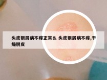 头皮银屑病不痒正常么 头皮银屑病不痒,干燥脱皮