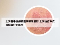 上海看牛皮癣的医院哪家最好 上海治疗牛皮病癣最好的医院