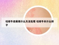 垃圾牛皮癣用什么方法处理 垃圾牛长什么样子