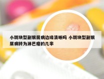 小斑块型副银屑病边缘清晰吗 小斑块型副银屑病转为淋巴瘤的几率