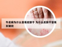 牛皮癣为什么容易皮肤干 为什么皮肤干容易长皱纹