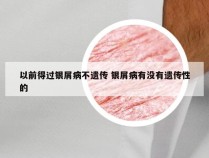 以前得过银屑病不遗传 银屑病有没有遗传性的