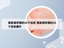 银屑病早期的10个征兆 银屑病早期的10个征兆图片