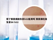 得了银屑病维生素b12能用吗 银屑病吃维生素b6 b12