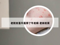 老脱皮是不是得了牛皮癣 老掉皮屑