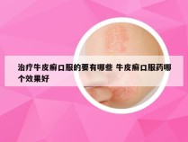 治疗牛皮癣口服的要有哪些 牛皮癣口服药哪个效果好