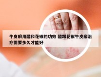 牛皮癣用醋和花椒的功效 醋跟花椒牛皮廨治疗需要多久才能好