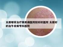 太原哪家治疗银屑病医院较好的医院 太原好的治牛皮癣专科医院