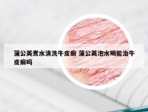蒲公英煮水清洗牛皮癣 蒲公英泡水喝能治牛皮癣吗