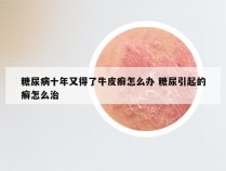 糖尿病十年又得了牛皮癣怎么办 糖尿引起的癣怎么治