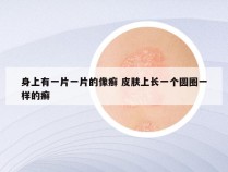 身上有一片一片的像癣 皮肤上长一个圆圈一样的癣
