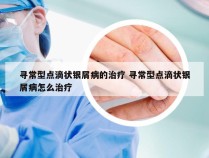 寻常型点滴状银屑病的治疗 寻常型点滴状银屑病怎么治疗