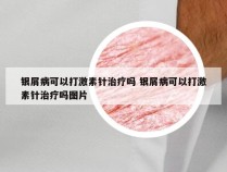 银屑病可以打激素针治疗吗 银屑病可以打激素针治疗吗图片