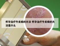 怀孕治疗牛皮癣的方法 怀孕治疗牛皮癣的方法是什么
