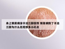 身上银屑病涂卡泊三醇搽剂 银屑病擦了卡泊三醇为什么出现很多小红点