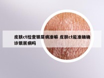 皮肤ct检查银屑病准嘛 皮肤ct能准确确诊银屑病吗